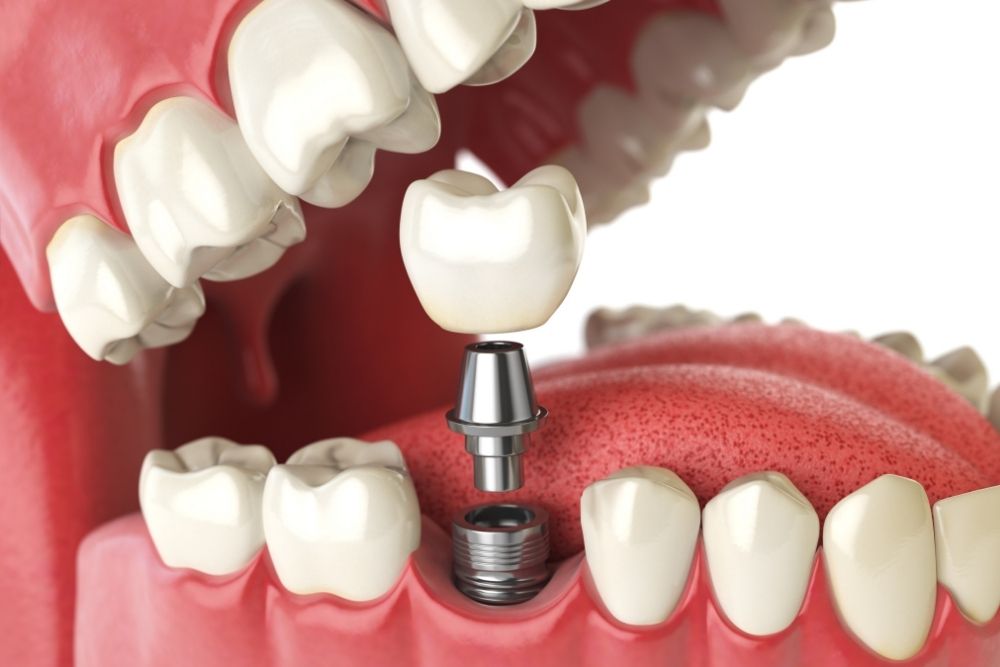 Dental Implants: Permanent Tooth Replacement Solutions 